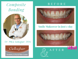 Best-Dentist-Eden-Prairie-MN-Dr-Mike-Gallagher-DDS-Composite-Bonding