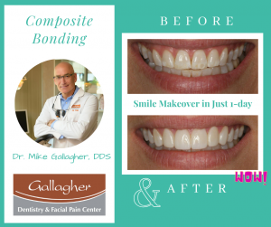 Best-Dentist-Eden-Prairie-MN-Dr-Mike-Gallagher-DDS-Composite-Bonding-1-Facebook-Post