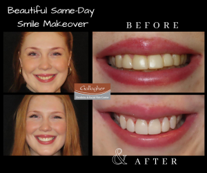 Best-Cosmetic-Dentist-Dr-Mike-Gallagher-DDS-Smile Makeover
